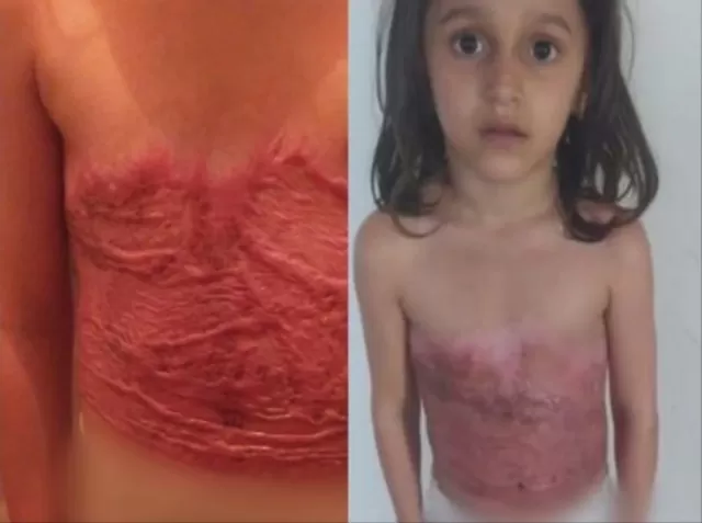 Ağır yanıq xəsarətləri alan məktəblinin köməyinizə ehtiyacı var
